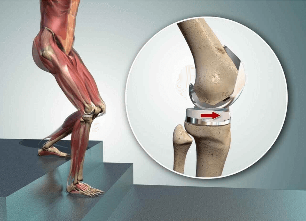 Восстановление после замены коленного сустава: как быстро вернуть здоровье