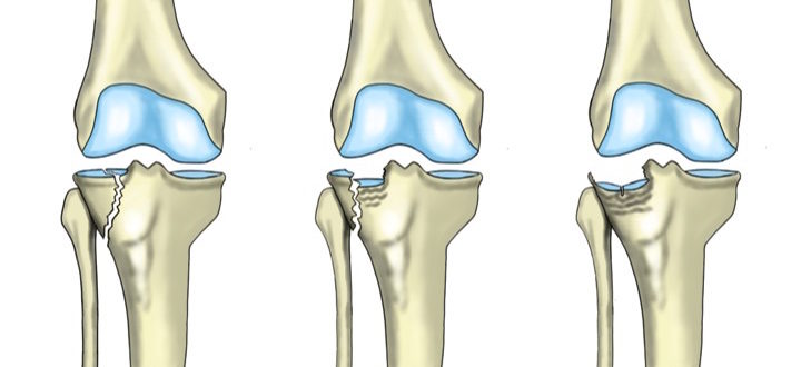 перелом коленного сустава