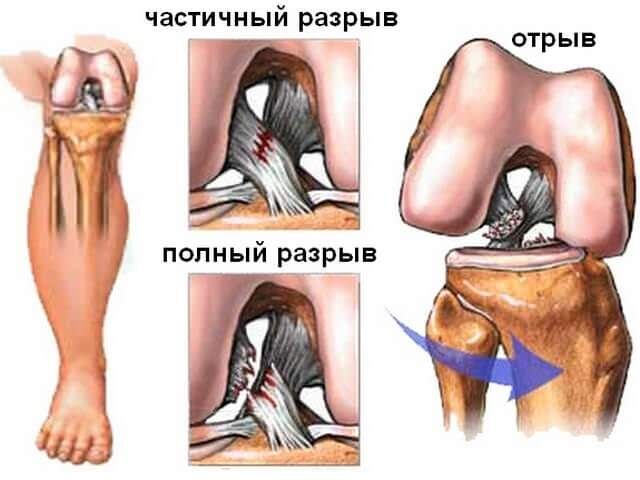 разрыв сухожилий коленного сустава